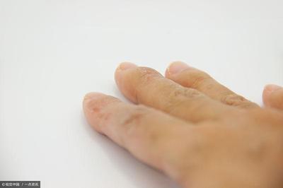 类风湿怎么治疗有效