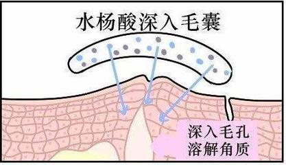 用醋涂痘痘