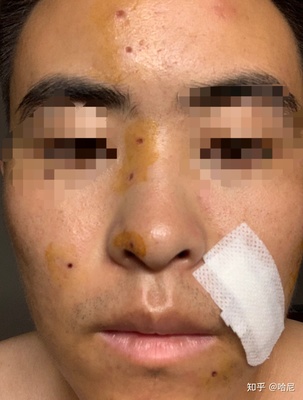点痣后又长出来了怎么办