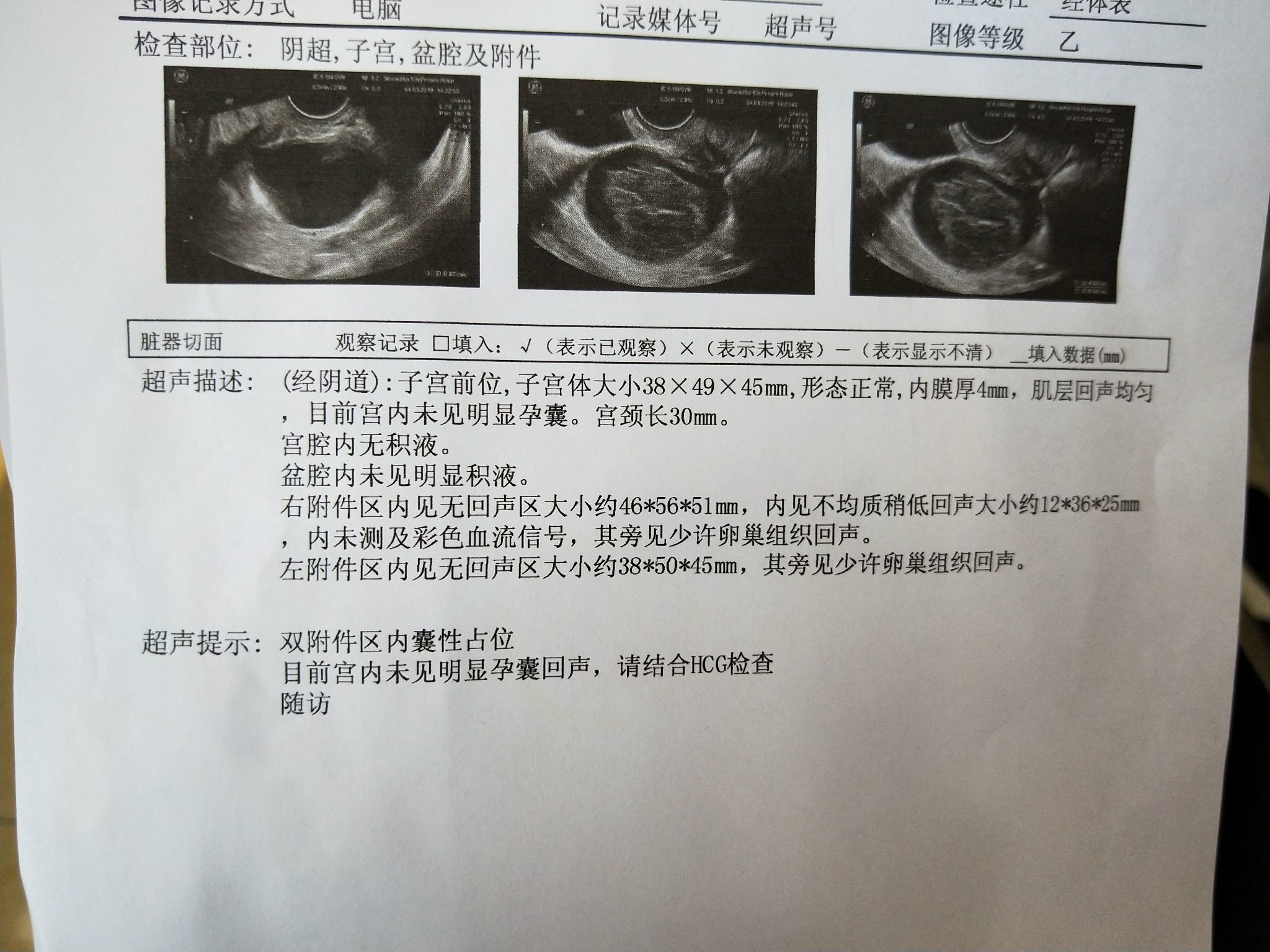 卵巢囊肿社保报销多少