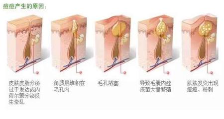 容易长痘痘怎么治