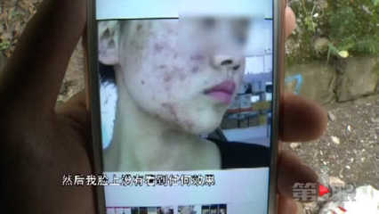 重庆市治痘痘朝天门熱线