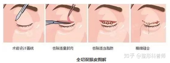 郑州韩式双眼皮