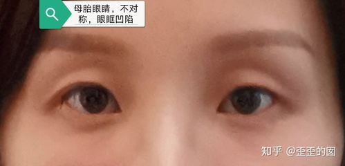 眼睛凹陷可以做双眼皮吗