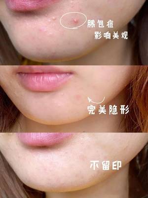 贴上痘痘贴化妆
