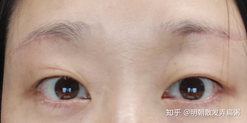 右眼皮肿是怎么回事