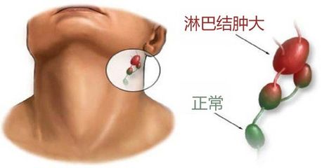 一岁宝宝耳后淋巴结肿大怎么办