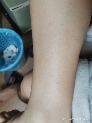 出血点是怎么回事