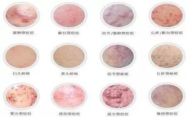 背上胸上长痘痘的原因