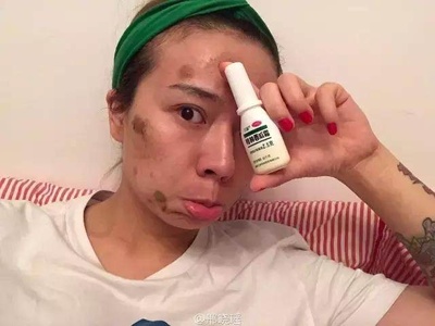 痘痘肿了用什么消肿