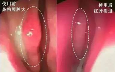 鼻粘膜肿大怎么治疗