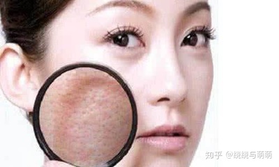 发痘痘忌口