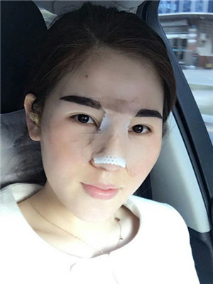 取耳软骨隆鼻疼吗