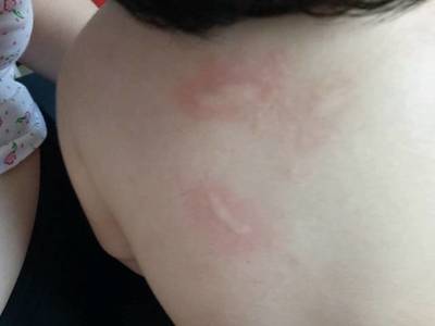 后背受潮起痘痘