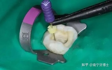 牙疼根管治疗是怎么治疗的