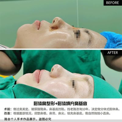 分体式隆鼻