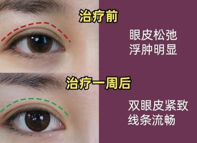 眼皮浮肿是怎么回事