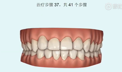 烤瓷牙步骤