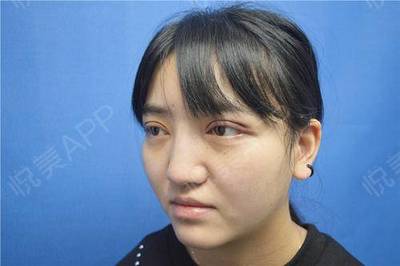 全切双眼皮拆线后注意事项