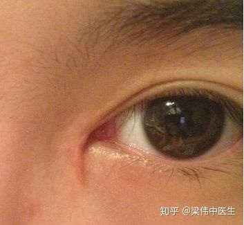 双眼皮忌口多久