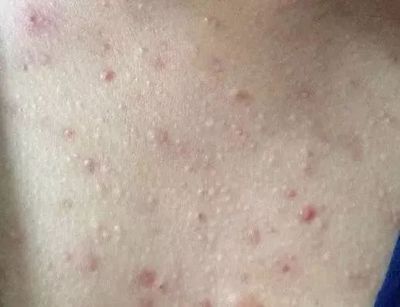 男人背上长痘痘用什么洗