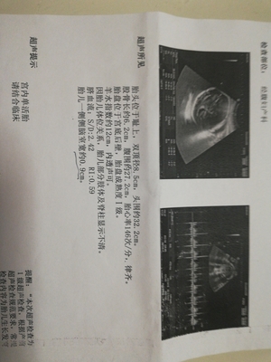 侧脑室宽说明胎儿聪明