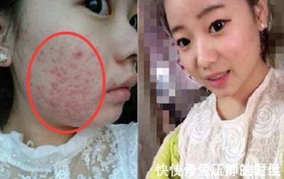 女孩脸颊长痘痘什么原因