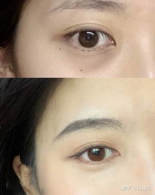 眼部有细纹怎么办