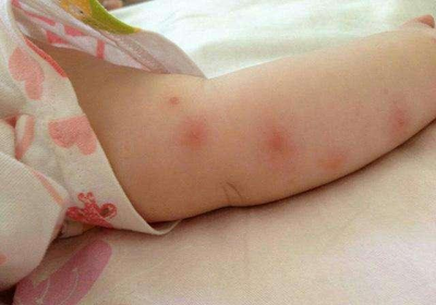 宝宝被蚊虫叮咬怎么办