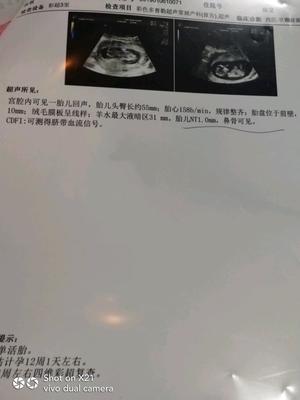 四个月可以做四维彩超吗