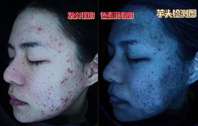 挤脓包痘痘怎么处理