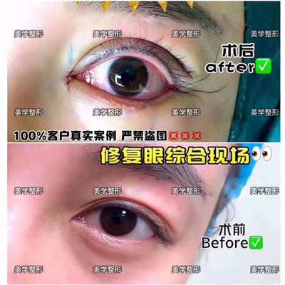 眼部整形的项目有哪些