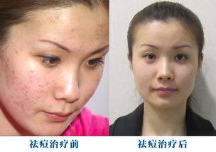 激光去痘痘哪里好