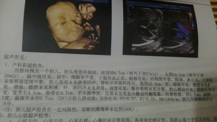 胎儿头偏大是什么原因