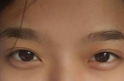 眼袋大是怎么回事