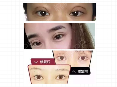 双眼皮弧度不一样高