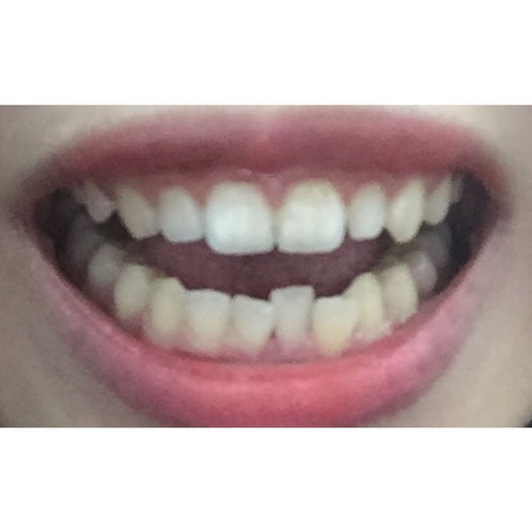 牙齿矫正只能在上排做吗?戴牙套一年后脸型的变化