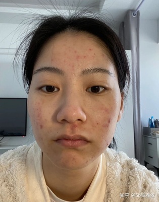 脸上有痘痘怎么掩盖