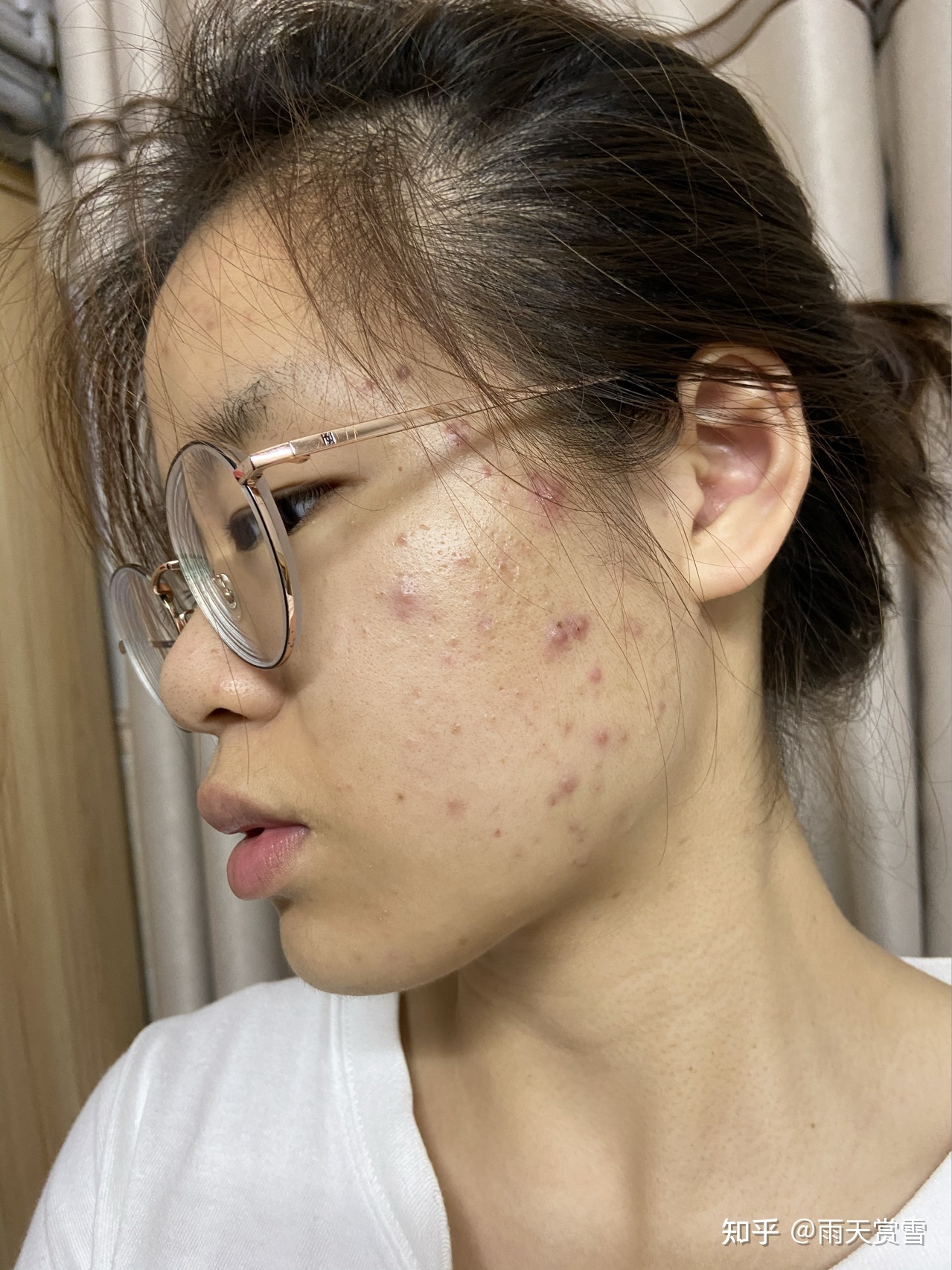 满脸痘印