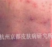 杭州看皮肤病价格是多少