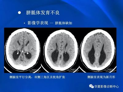 侧脑室扩张是怎么回事