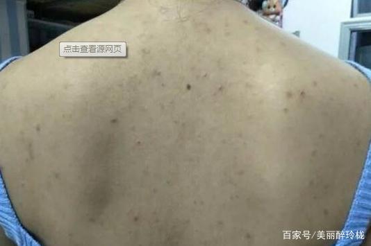 后背起痘痘 好多年
