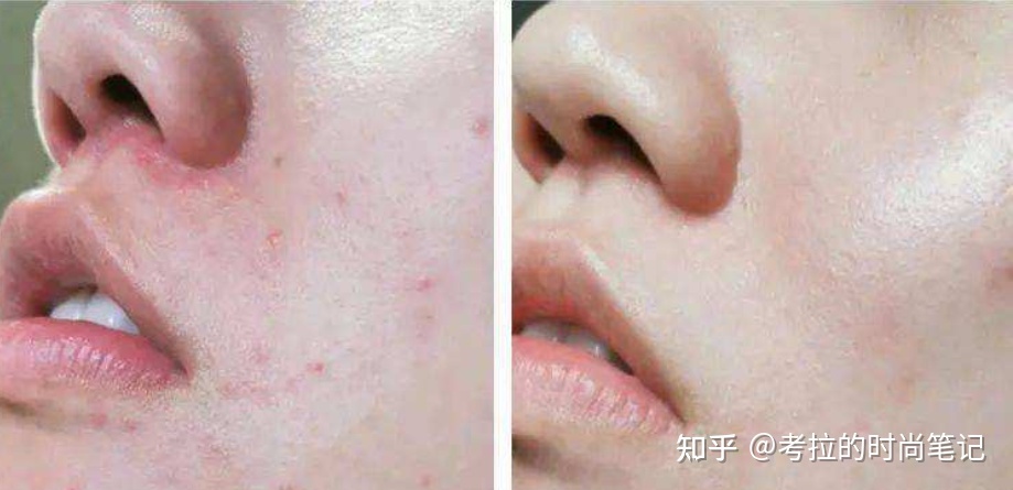 痘痘泛红是怎麽回事
