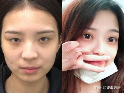 割了双眼皮后特后悔