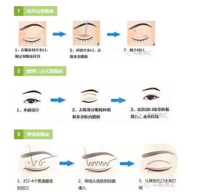点式双眼皮
