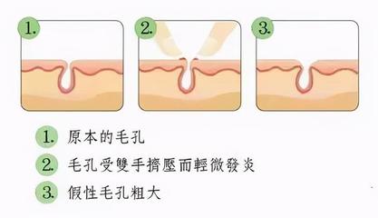 三角区毛孔大怎么办