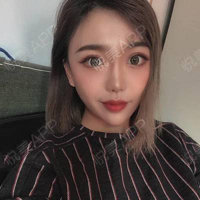 开眼角拆线后多久化妆
