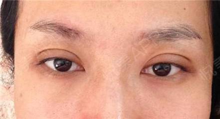 做双眼皮淤青多久能好