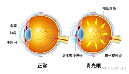 眼睛眼压高是怎么回事