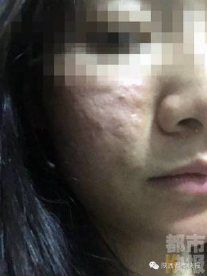 用水光针会起痘痘